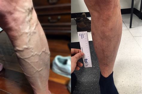 The only sure way to reduce tolerance is lower your dose or take a break. . Varicose veins adderall reddit